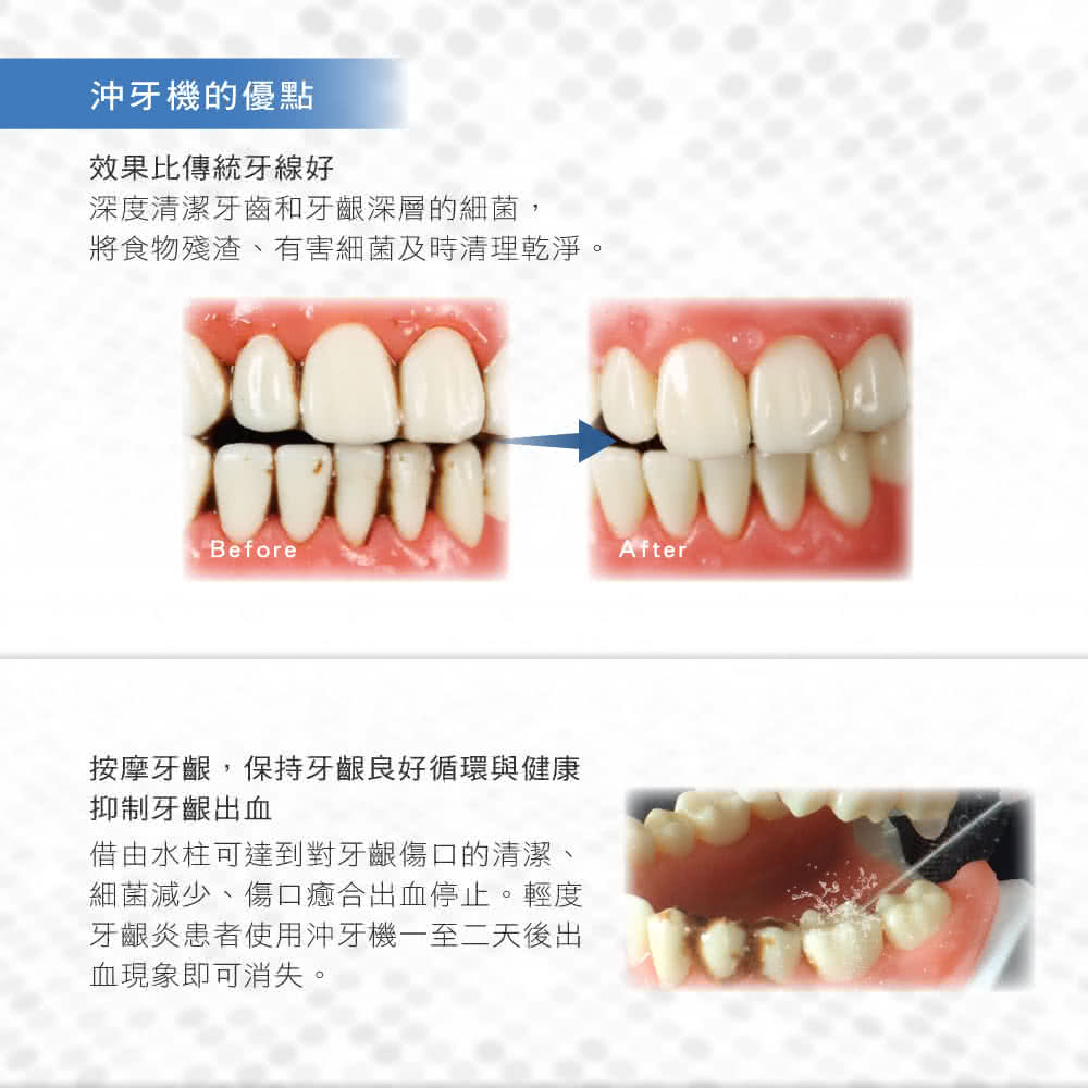 沖牙機的優點效果比傳統牙線好深度清潔牙齒和牙齦深層的細菌,將食物殘渣、有害細菌及時清理乾淨。BeforeAfter按摩牙齦,保持牙齦良好循環與健康抑制牙齦出血借由水柱可達到對牙齦傷口的清潔、細菌減少、傷口癒合出血停止。輕度牙齦炎患者使用沖牙機一至二天後出血現象即可消失。